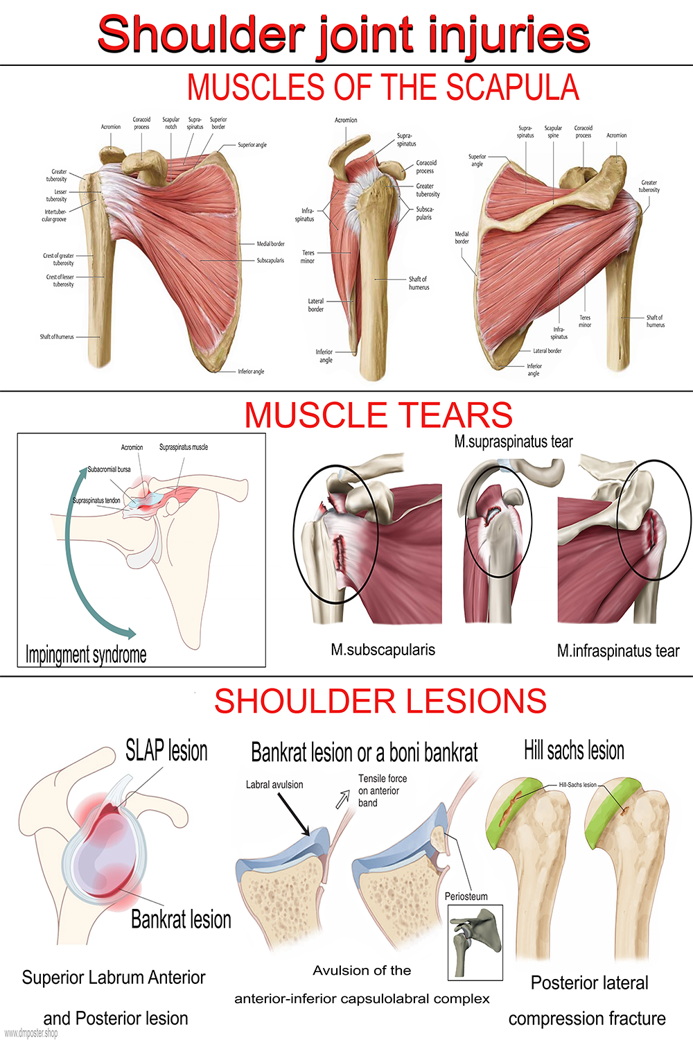 Shoulder Joint Injuries: Comprehensive Guide with Muscle Anatomy, Tears, and Lesions- High-Resolution Educational Poster