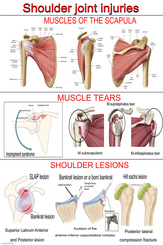 Shoulder Joint Injuries: Comprehensive Guide with Muscle Anatomy, Tears, and Lesions- High-Resolution PDF| Ready-to-Print Educational Poster